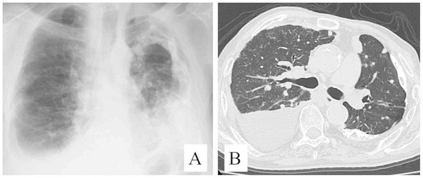 甲状腺がん 胸膜播種 甲状腺がん 胸膜播種