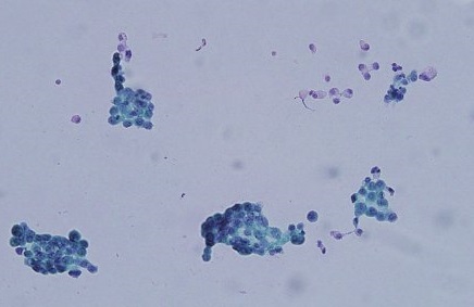 甲状腺癌の胸膜転移(胸膜播種) 胸水細胞診 甲状腺癌の胸膜転移(胸膜播種) 胸水細胞診