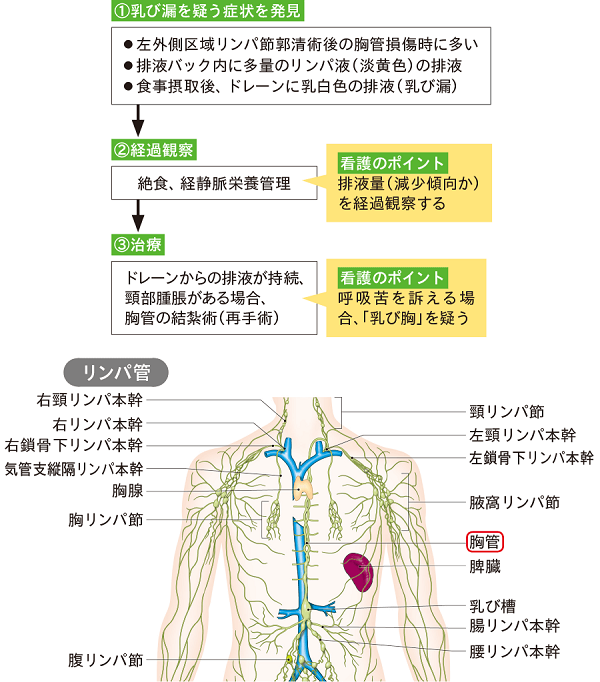 乳び胸水(乳び漏) 乳び胸水(乳び漏)