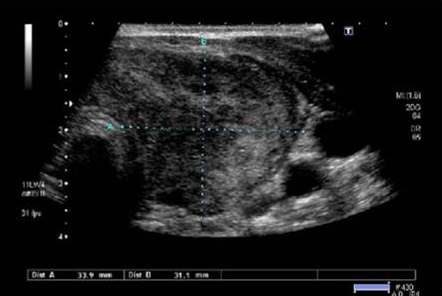 肺癌からの転移性甲状腺癌 肺癌からの転移性甲状腺癌