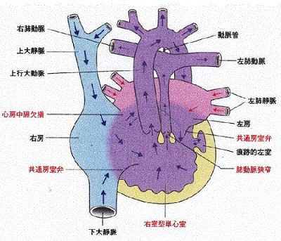 単心室症 単心室症