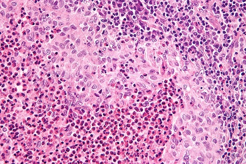 ランゲルハンス細胞組織球症 組織像 ランゲルハンス細胞組織球症 組織像
