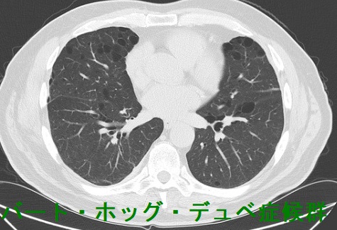 Birt-Hogg-Dube (BHD) 症候群(バート・ホッグ・デュベ症候群) Birt-Hogg-Dube (BHD) 症候群(バート・ホッグ・デュベ症候群)