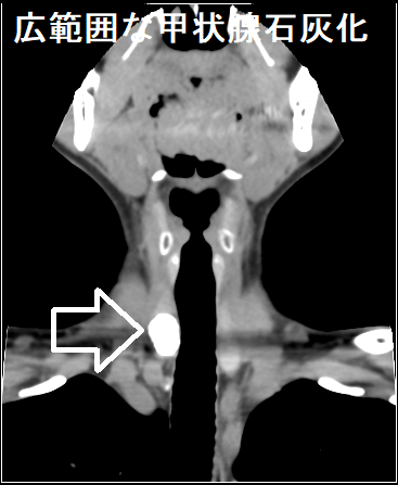 広範囲な甲状腺石灰化 CT1 広範囲な甲状腺石灰化 CT1