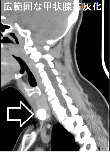 広範囲な甲状腺石灰化 CT画像2 広範囲な甲状腺石灰化 CT画像2