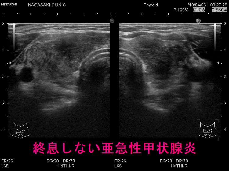 終息しない亜急性甲状腺炎 終息しない亜急性甲状腺炎