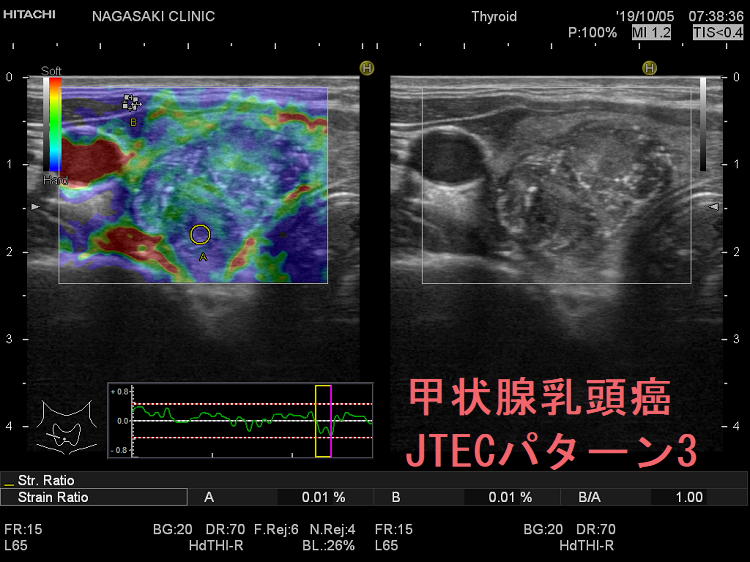 表在エコーの実学─乳腺・甲状腺・その他─ | 杉山 高 |本