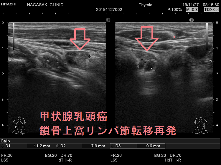 甲状腺乳頭癌 左鎖骨上窩リンパ節転移再発 超音波(エコー)画像 甲状腺乳頭癌 左鎖骨上窩リンパ節転移再発 超音波(エコー)画像