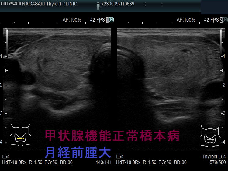 甲状腺機能正常橋本病 月経前腫大 超音波(エコー)画像 甲状腺機能正常橋本病 月経前腫大 超音波(エコー)画像