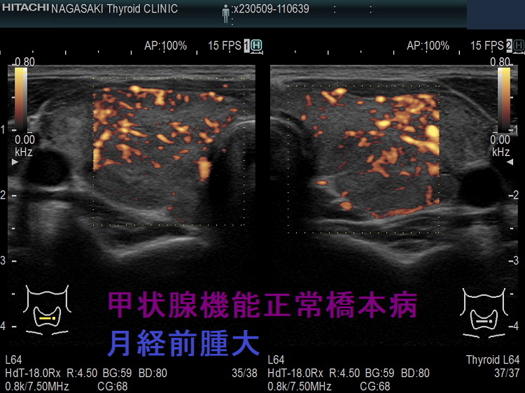 甲状腺機能正常橋本病 月経前腫大 ドプラーモード 甲状腺機能正常橋本病 月経前腫大 ドプラーモード