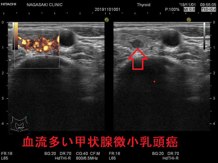 血流多い微小乳頭癌 超音波(エコー)画像 血流多い微小乳頭癌 超音波(エコー)画像