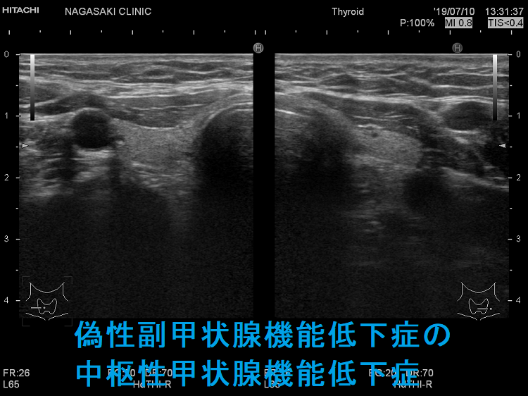 偽性副甲状腺機能低下症の中枢性甲状腺機能低下症 偽性副甲状腺機能低下症の中枢性甲状腺機能低下症