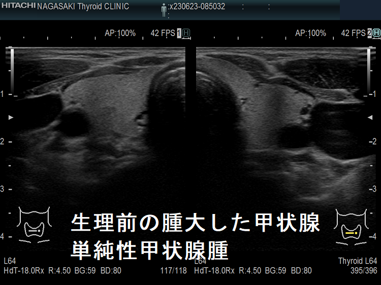 生理前の腫大した甲状腺 単純性甲状腺腫 生理前の腫大した甲状腺 単純性甲状腺腫