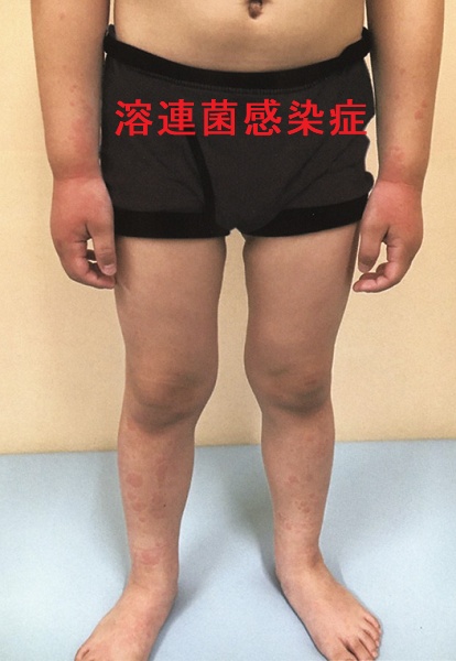 溶連菌感染症四肢に発疹(癒合傾向のある紅色小丘疹) 溶連菌感染症四肢に発疹(癒合傾向のある紅色小丘疹)