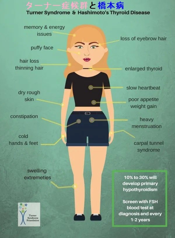 ターナー症候群と甲状腺 ターナー症候群と甲状腺
