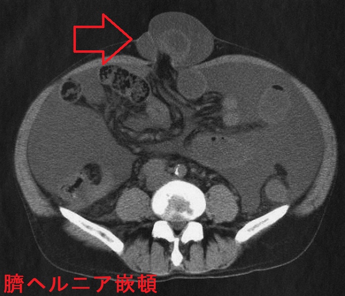 臍ヘルニア嵌頓 腹部単純CT 臍ヘルニア嵌頓 腹部単純CT
