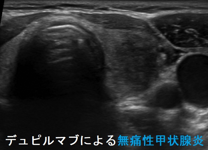 デュピルマブによる無痛性甲状腺炎 デュピルマブによる無痛性甲状腺炎
