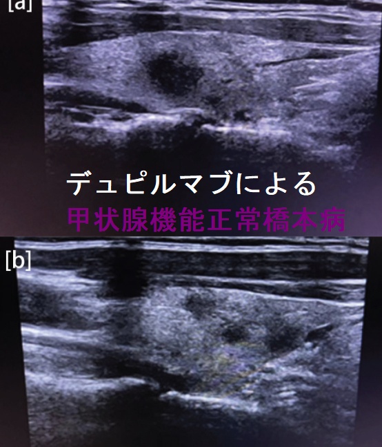 デュピルマブによる甲状腺機能正常橋本病 デュピルマブによる甲状腺機能正常橋本病