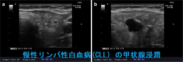 甲状腺以外の悪性リンパ腫(唾液腺MALT 血管内リンパ腫 頚部悪性 甲状腺以外の悪性リンパ腫(唾液腺MALT 血管内リンパ腫 頚部悪性