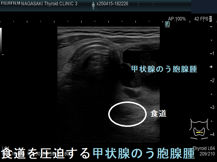 食道を圧迫する甲状腺のう胞腺腫 食道を圧迫する甲状腺のう胞腺腫
