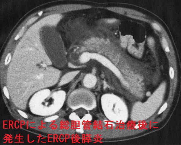 ERCP による総胆管結石治療後に発生したERCP 後膵炎 ERCP による総胆管結石治療後に発生したERCP 後膵炎