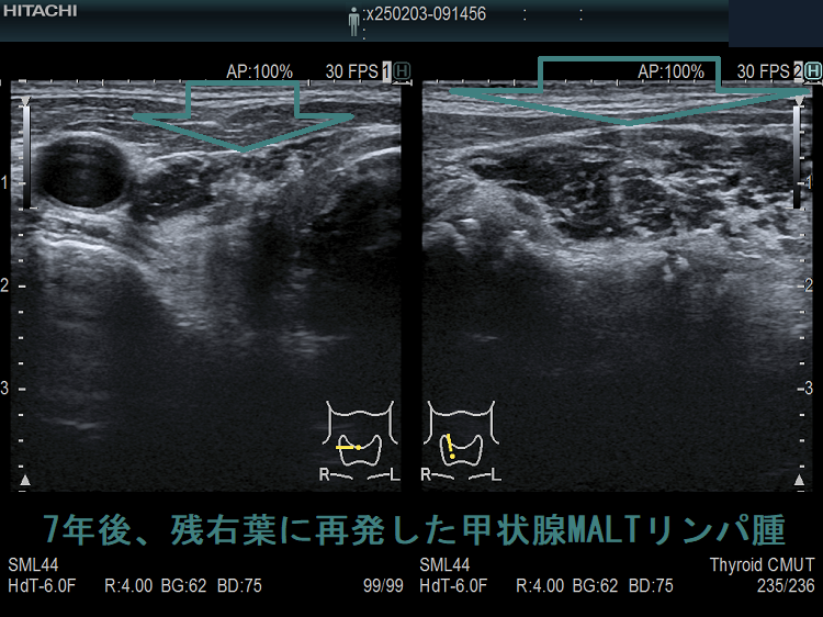 7年後、残右葉に再発した甲状腺MALTリンパ腫 超音波(エコー)画像 7年後、残右葉に再発した甲状腺MALTリンパ腫 超音波(エコー)画像