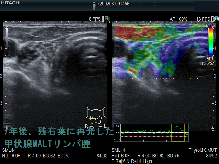7年後、残右葉に再発した甲状腺MALTリンパ腫 エラストグラフィー 7年後、残右葉に再発した甲状腺MALTリンパ腫 エラストグラフィー