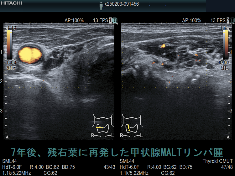 7年後、残右葉に再発した甲状腺MALTリンパ腫 超音波(エコー)画像 ドプラーモード 7年後、残右葉に再発した甲状腺MALTリンパ腫 超音波(エコー)画像 ドプラーモード