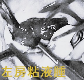 左房粘液腫 腫瘤摘除術中の写真 左房粘液腫 腫瘤摘除術中の写真