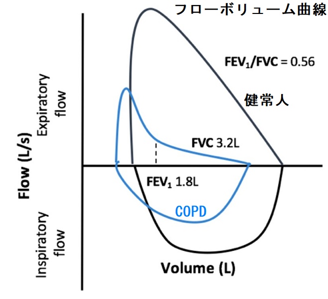 COPD フローボリューム曲線 COPD フローボリューム曲線