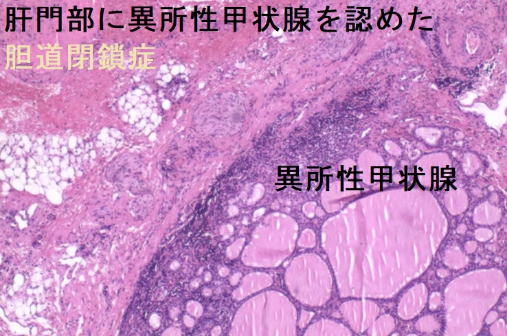 肝門部に異所性甲状腺を認めた胆道閉鎖症 肝門部に異所性甲状腺を認めた胆道閉鎖症
