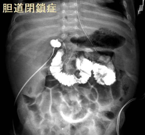 肝硬変のノンサイロイダルイルネス、肝性脳症が甲状腺機能低下症
