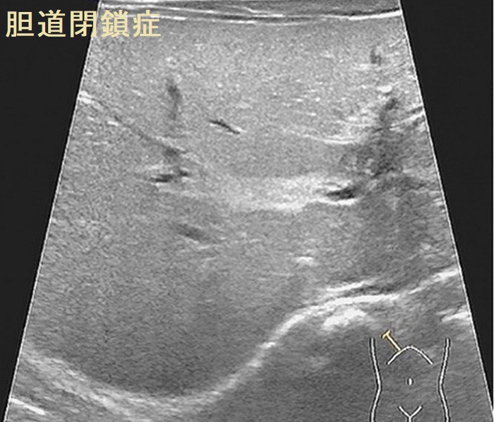 肝硬変のノンサイロイダルイルネス、肝性脳症が甲状腺機能低下症