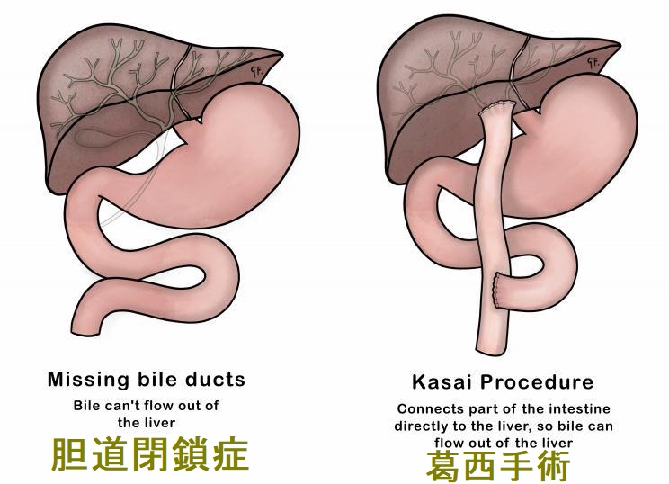 肝硬変のノンサイロイダルイルネス、肝性脳症が甲状腺機能低下症