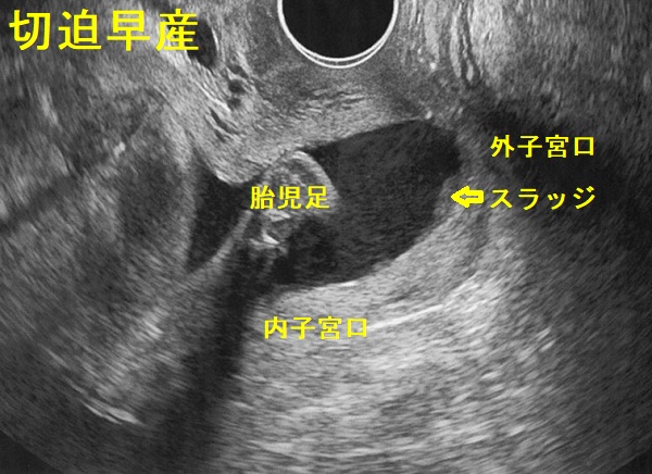 切迫早産 経腟超音波画像 切迫早産 経腟超音波画像