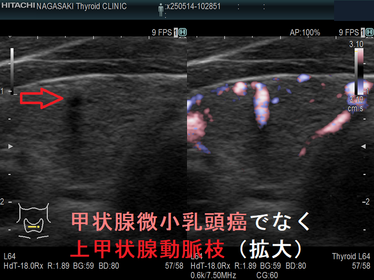 甲状腺微小乳頭癌でなく上甲状腺動脈分枝(水平断)(拡大) 甲状腺微小乳頭癌でなく上甲状腺動脈分枝(水平断)(拡大)