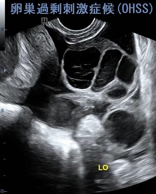 卵巣過剰刺激症候群(OHSS) 経腟超音波(エコー)画像 卵巣過剰刺激症候群(OHSS) 経腟超音波(エコー)画像