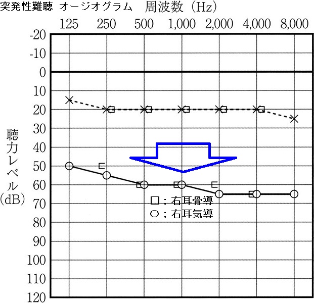 突発性難聴 オージオグラム 突発性難聴 オージオグラム