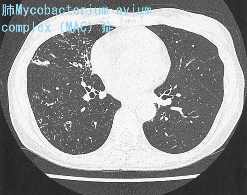 肺Mycobacterium avium complex(MAC)症 胸部単純CT 肺Mycobacterium avium complex(MAC)症 胸部単純CT