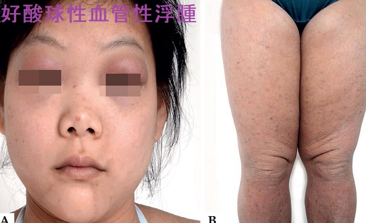 好酸球性血管性浮腫 好酸球性血管性浮腫