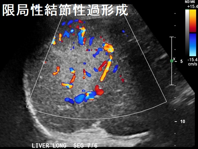 限局性結節性過形成 超音波(エコー)画像 限局性結節性過形成 超音波(エコー)画像