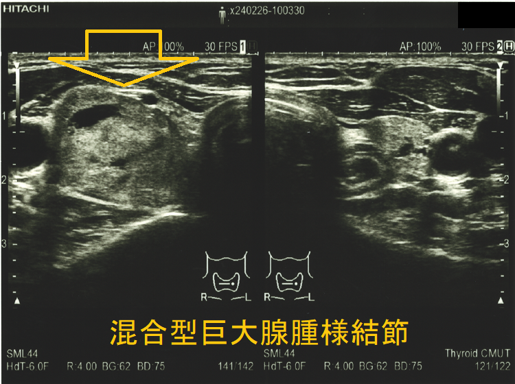 4cmを超える混合型巨大腺腫様結節 4cmを超える混合型巨大腺腫様結節