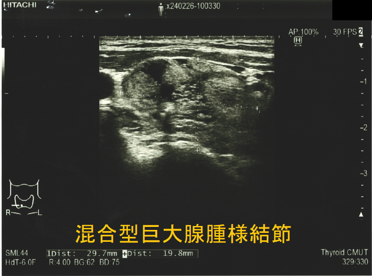 4cmを超える混合型巨大腺腫様結節(水平断) 4cmを超える混合型巨大腺腫様結節(水平断)