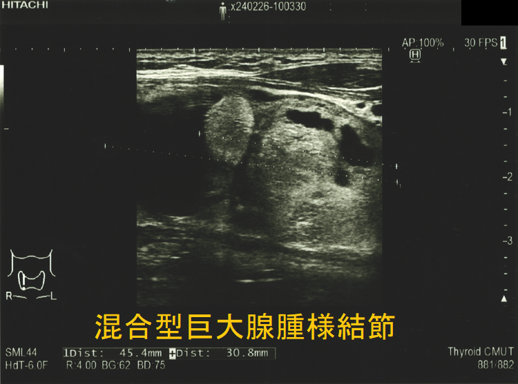 4cmを超える混合型巨大腺腫様結節(矢状断) 4cmを超える混合型巨大腺腫様結節(矢状断)