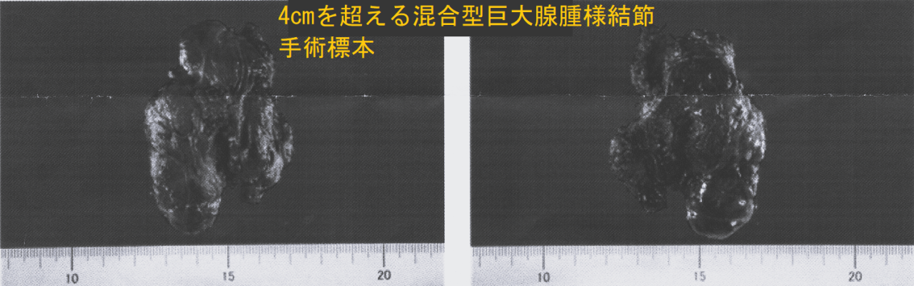 4cmを超える混合型巨大腺腫様結節 手術標本 4cmを超える混合型巨大腺腫様結節 手術標本