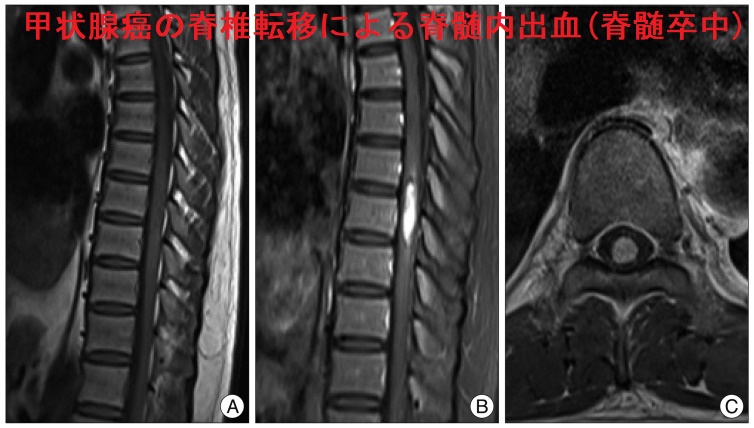 甲状腺癌の脊椎転移(T7-8 )による脊髄内出血(脊髄卒中) 甲状腺癌の脊椎転移(T7-8 )による脊髄内出血(脊髄卒中)
