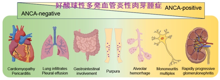 好酸球性多発血管炎性肉芽腫症(EGPA) 好酸球性多発血管炎性肉芽腫症(EGPA)
