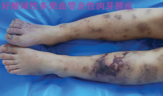 好酸球性多発血管炎性肉芽腫症 下肢病変 好酸球性多発血管炎性肉芽腫症 下肢病変