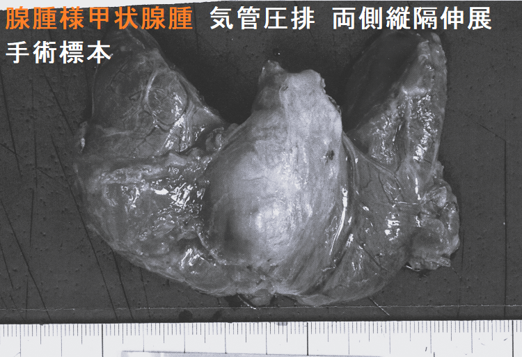 腺腫様甲状腺腫 気管圧排 両側縦隔伸展 手術標本1-1 腺腫様甲状腺腫 気管圧排 両側縦隔伸展 手術標本1-1
