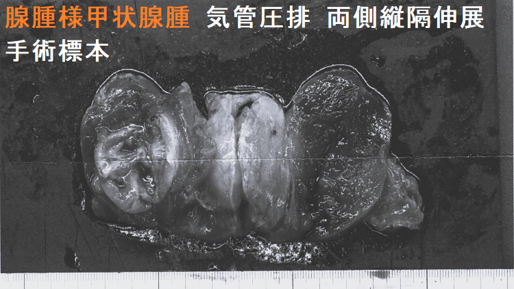 腺腫様甲状腺腫 気管圧排 両側縦隔伸展 手術標本2-2 腺腫様甲状腺腫 気管圧排 両側縦隔伸展 手術標本2-2